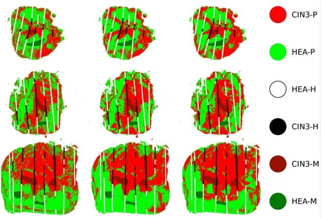 Machine Learning-Based Detection of Cervical Intraepithelial Neoplasia: Diagnostic Performance