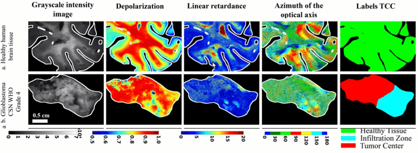 Distinguishing Brain Tumor from Tumor-Free Brain Tissue
